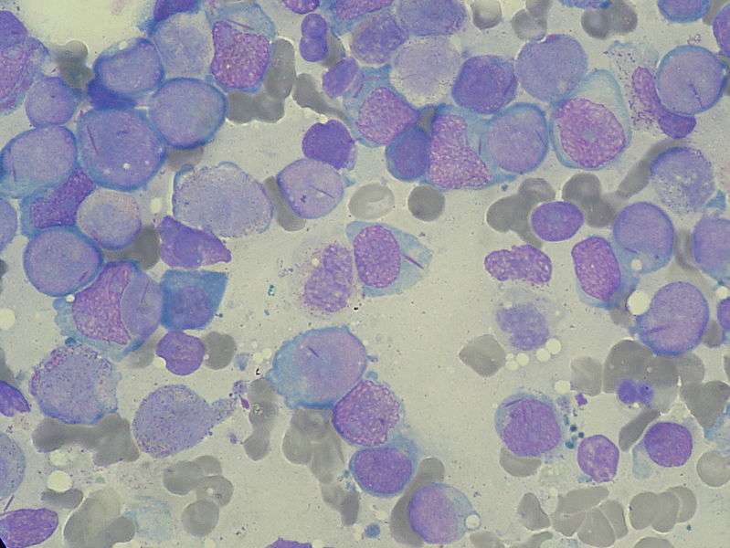 Myeloblasts with Auer rods seen in acute myeloid leukemia (AML)