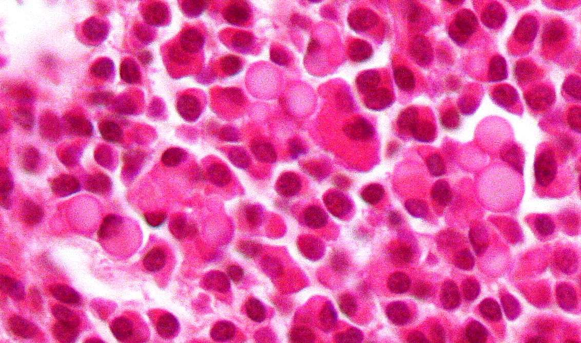 Micrograph of a plasmacytoma