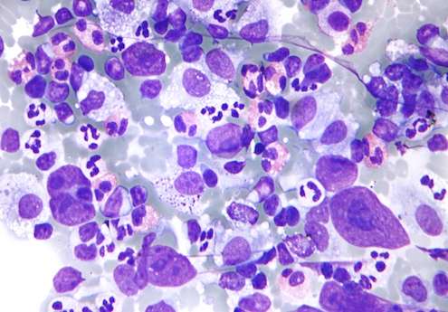 The REAL classification of lymphoma